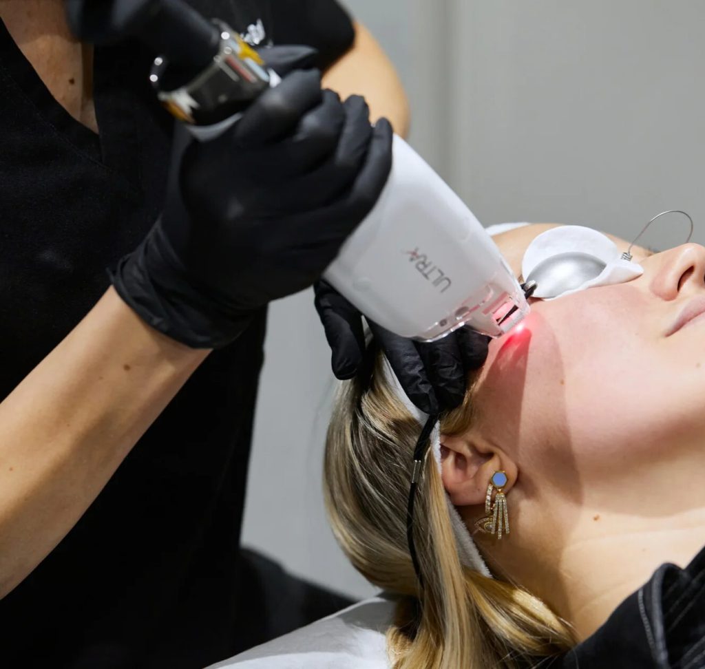 Beautician guiding the ULTRA thulium laser over a client’s cheek, eyes protected by laser shields