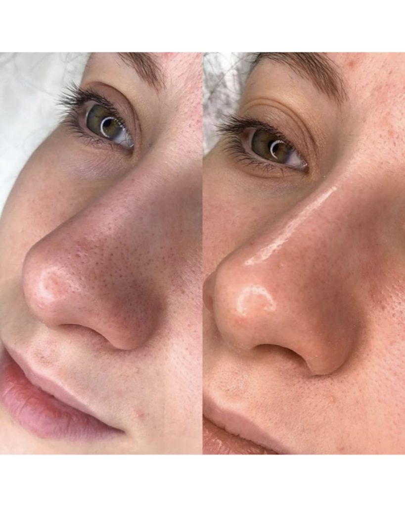 Mitesser entfernen Vorher Nachher: links Nase mit sichtbaren Mitessern, rechts klarere Poren nach der Behandlung