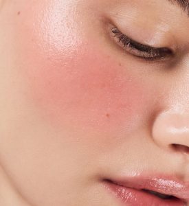 Reddened, sensitive cheek before the first treatment