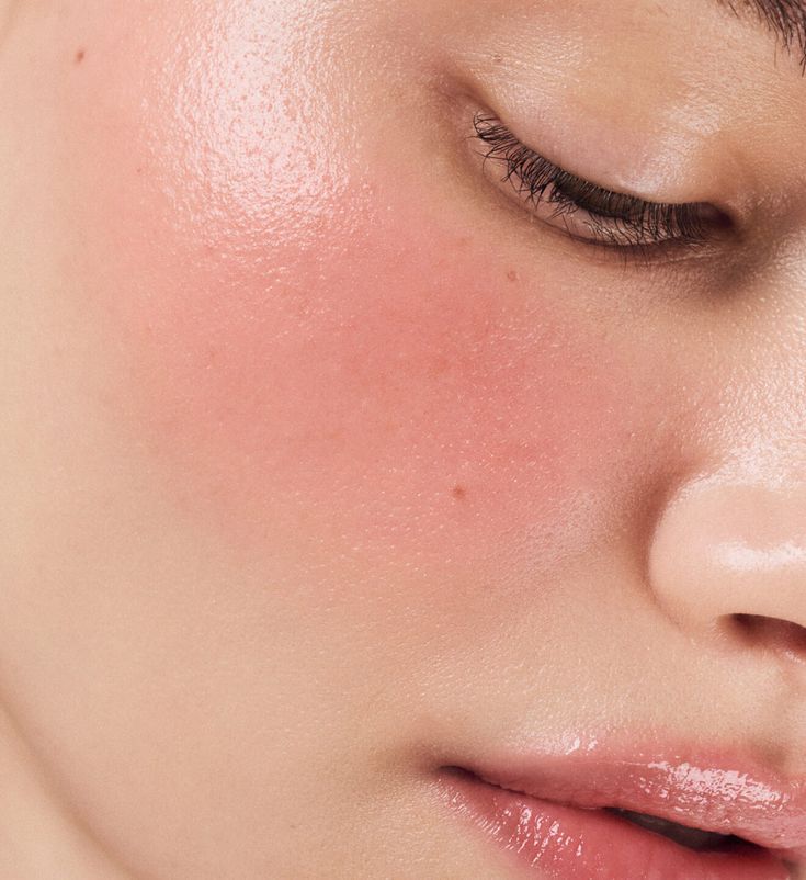 Reddened, sensitive cheek before the first treatment