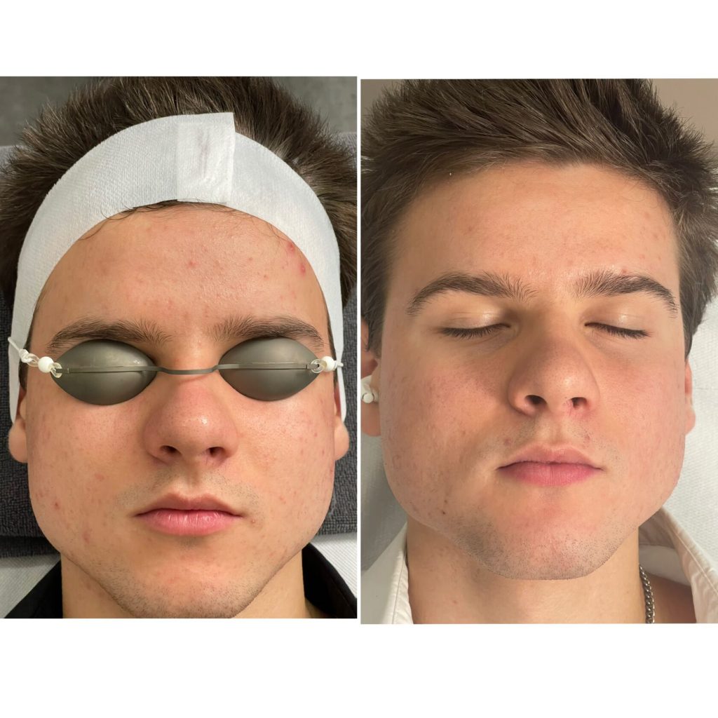 Young man before and after with clearer skin - men's skincare result in Vienna