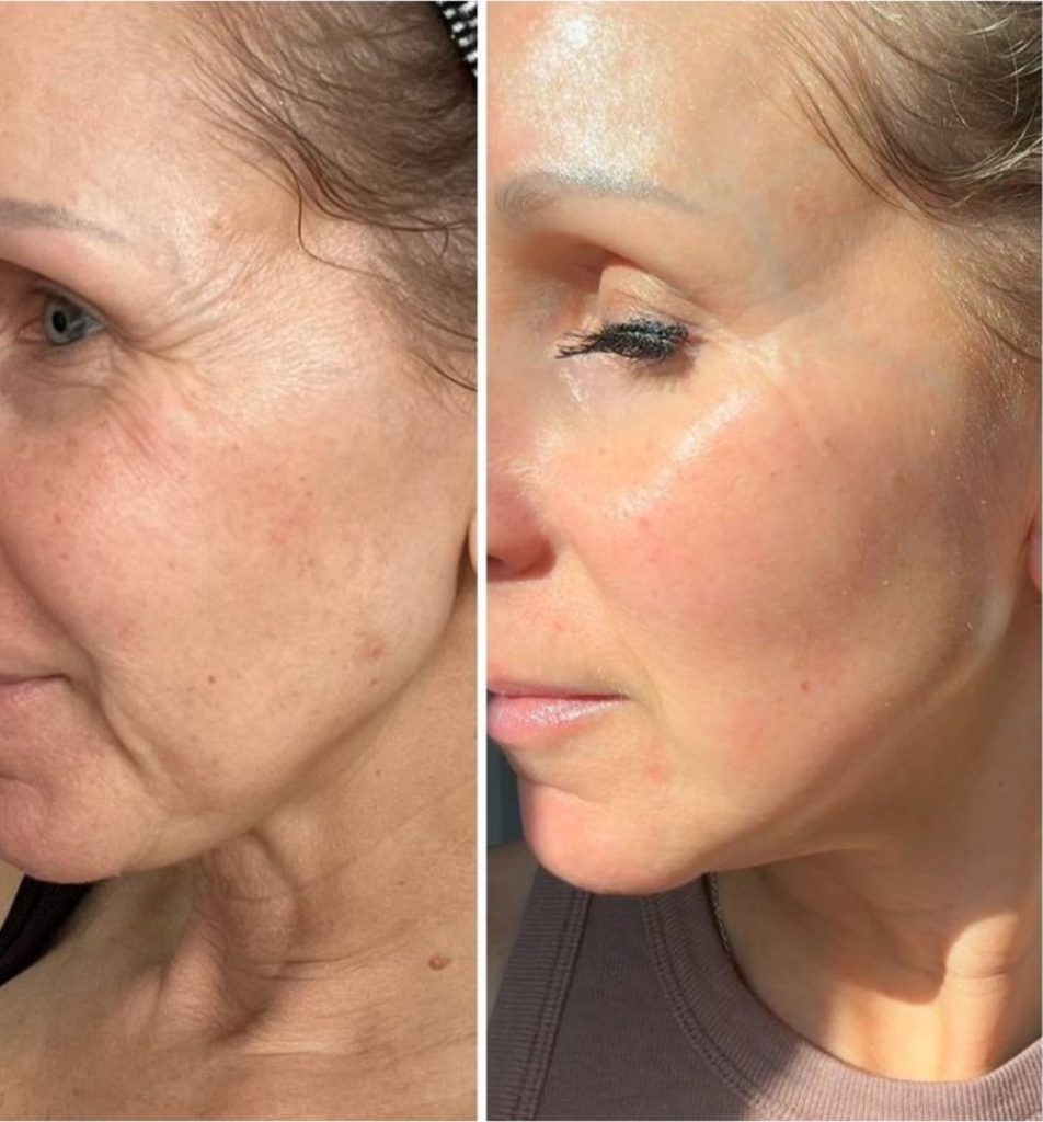 Before and after of the cheek with smoother skin - thulium laser result in Vienna