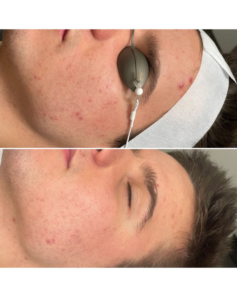 Men’s skincare before and after: blemished, reddened skin on top, a calmer and clearer complexion below