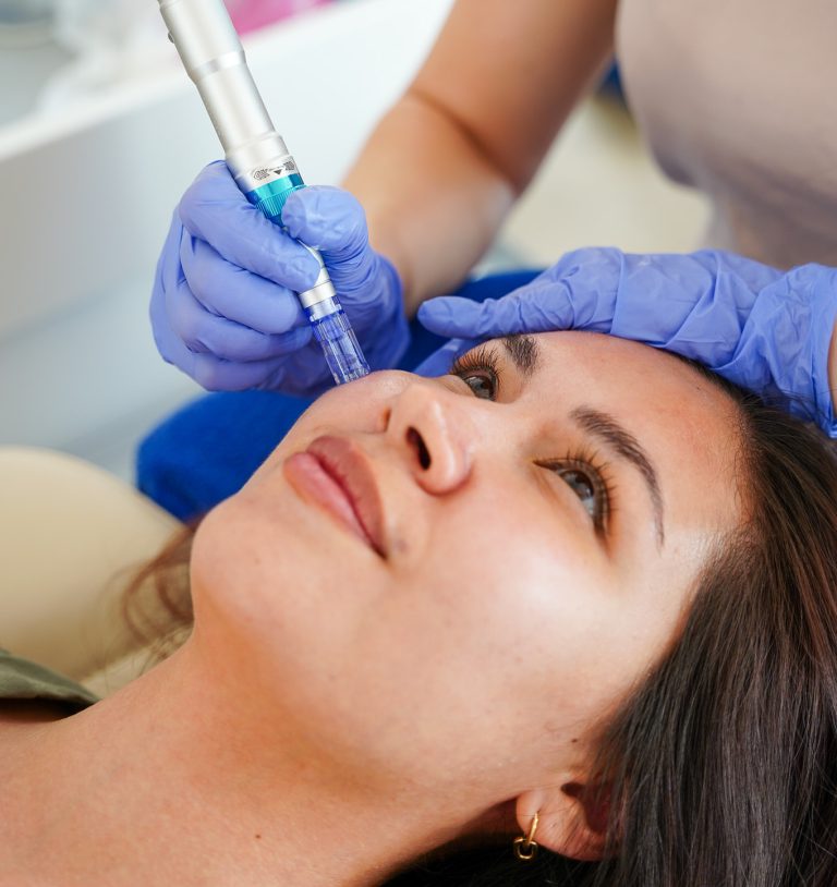 Microneedling pen guided over the cheek - microneedling treatment in Vienna