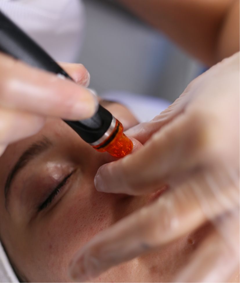 Close-up of skin before treatment – concerns such as acne and pores