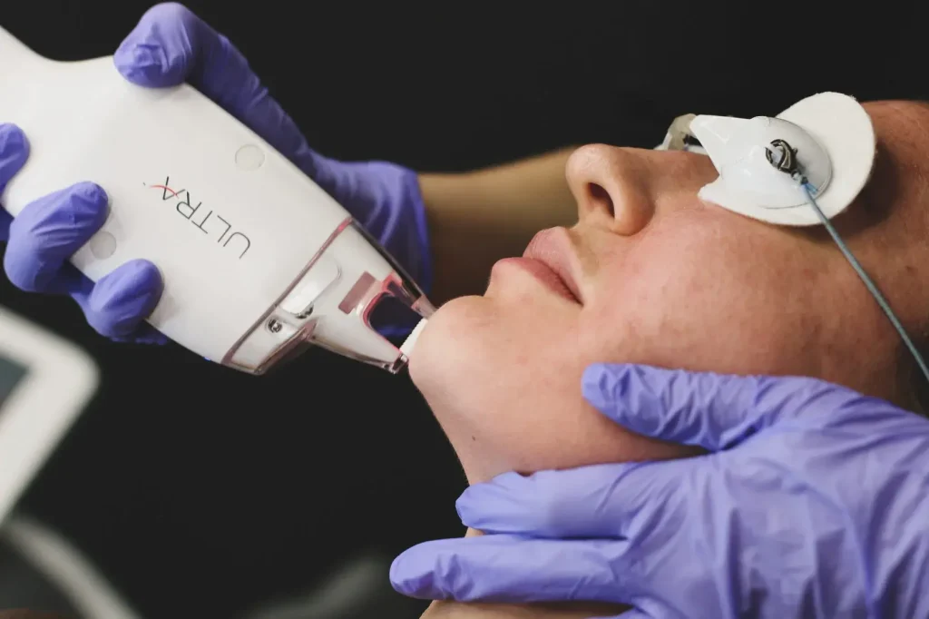 ULTRA laser handpiece on the face with eye shield - thulium laser treatment in Vienna